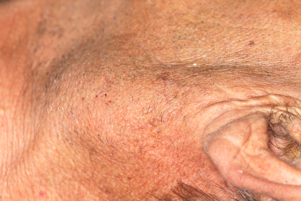Цистаденолимфом - клиничен изглед