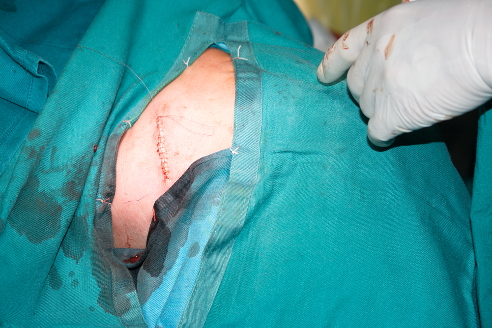 Зашита оперативна рана